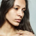 combatir las ojeras
