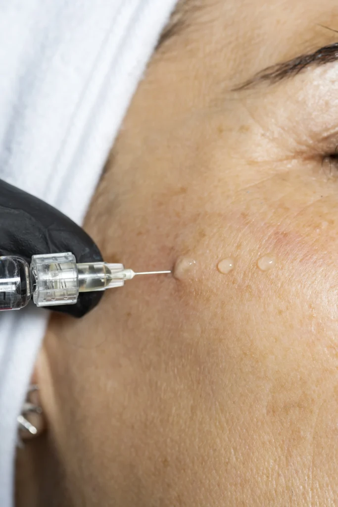 mesoterapia